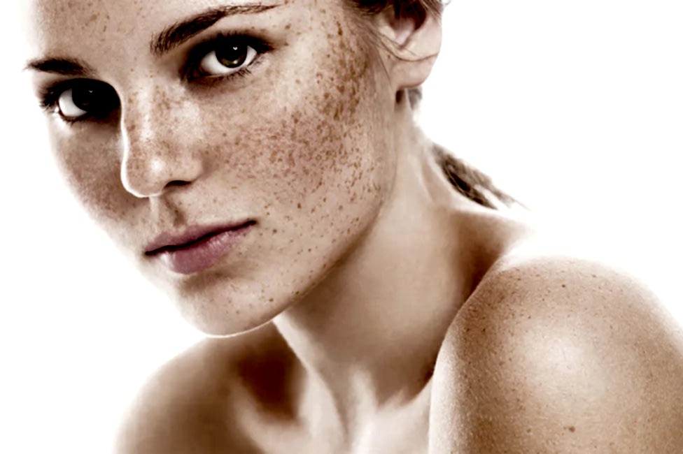 Лазерное удаление пигментации