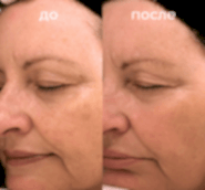 Фотолечение BBL