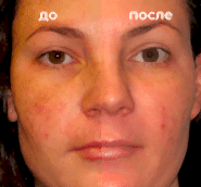 Фотолечение BBL