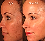 Фотолечение BBL