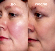 Фотолечение BBL