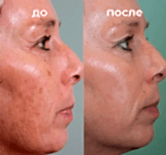 Фотолечение BBL