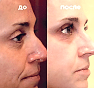 Фотолечение BBL